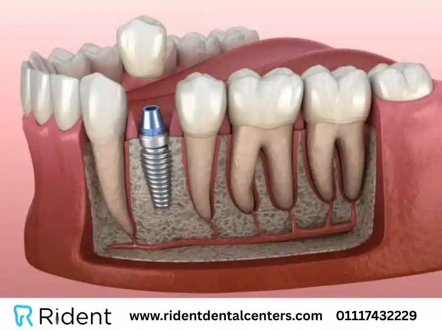 الفرق بين زراعة الأسنان الفورية والتقليدية